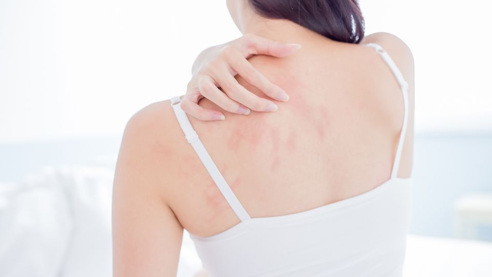eczema treatment glasgow